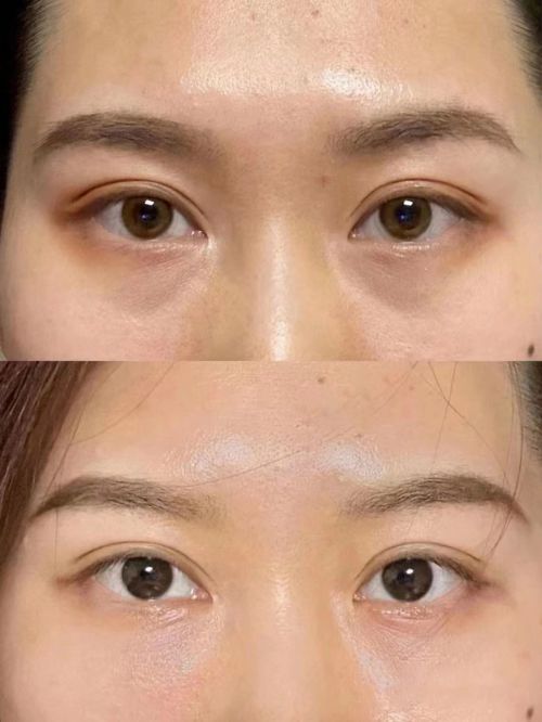 霜！去眼袋最有效的眼霜top5龙8国际唯一去眼袋第一名的眼(图1)